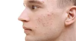 experto etiología del acné