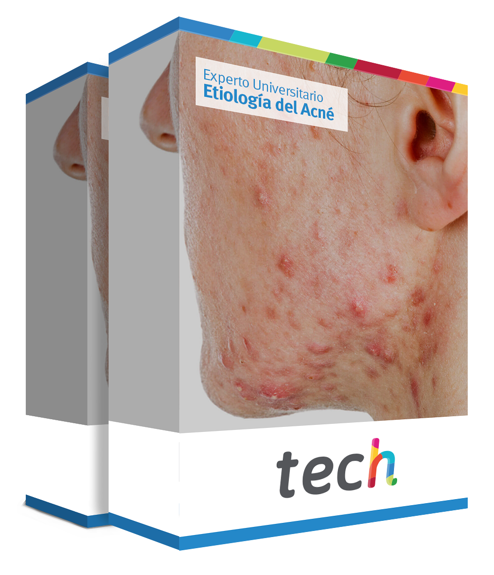 especializacion etiologia acne caja