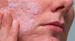 especializacion online tratamientos modernos y otros tratamientos del acné y sus cicatrices