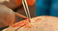 curso tricologia trasplante capilar 2