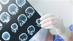 posgrado traumatismos neurooncologia
