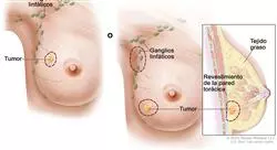 curso cirugía plástica y reconstructiva de mama