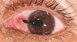 especializacion cirugía oftalmológica