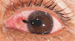 especializacion patologías oculares y tratamiento