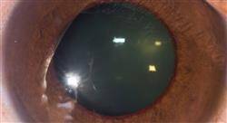 especializacion glaucoma y patología ocular pediátrica