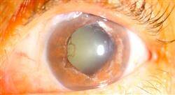 especializacion online glaucoma y patología ocular pediátrica