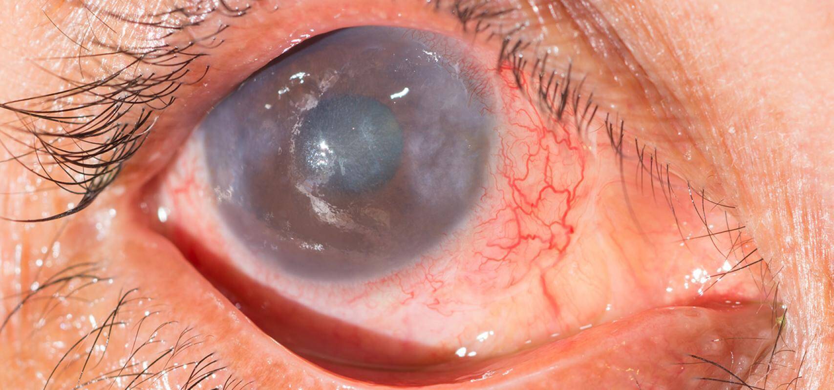 Especialización Universitaria en Uveitis y Retina