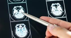 especializacion online métodos diagnósticos neurona motora y ataxias