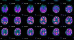 estudiar patologías neurodegenerativas