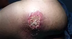 experto resistencia antimicrobiana tratamiento infeccion nosocomial l