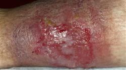 posgrado diagnostico tratamiento infecciones causadas bacterias