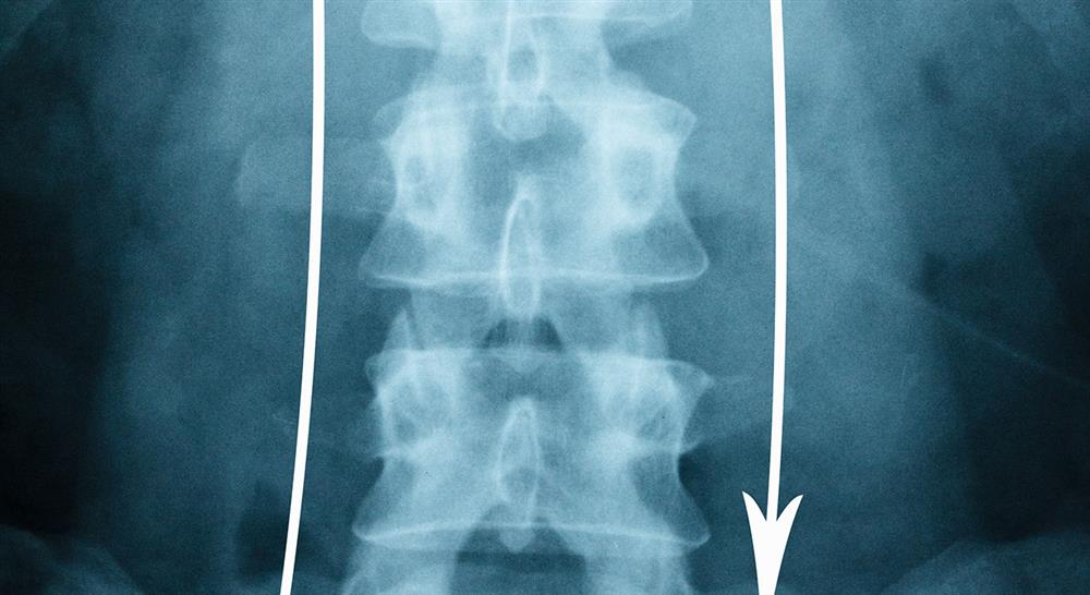 estudiar avances en el tratamiento de las deformidades vertebrales y patología degenerativa dorsolumbar