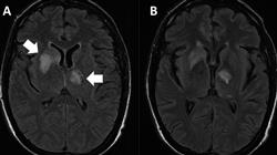 curso online diagnostico tratamiento enfermedades micoticas