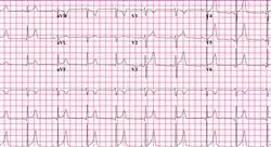 cursos insuficiencia cardíaca shock cardiogénico y síndrome coronario agudo