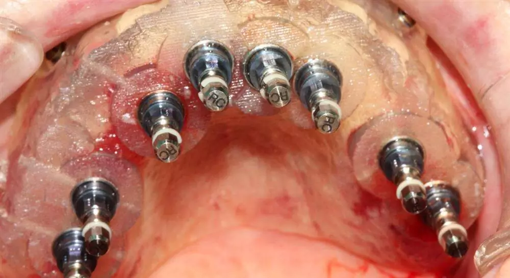 master implantología y cirugía oral