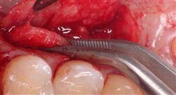 maestria online implantología y cirugía oral