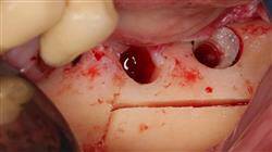 maestria onlinne implantologia cirugia oral
