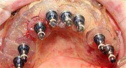 master implantología y cirugía oral