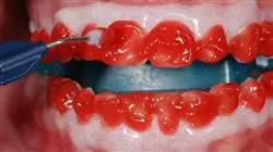 curso online blanqueamiento dental