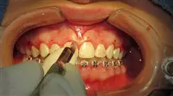 diplomado online blanqueamiento dental