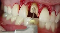 master online endodoncia microcirugia apical