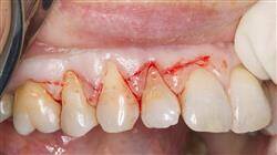 especializacion online cirugia mucogingival periodoncia