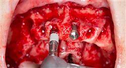 especializacion online cirugía mucogingival en periodoncia