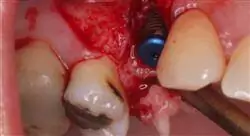 cursos cirugía regenerativa en periodoncia
