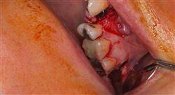 especializacion cirugía periodontal básica y láser en periodoncia