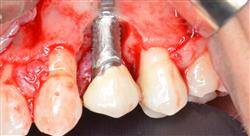 estudiar cirugía periodontal básica y láser en periodoncia