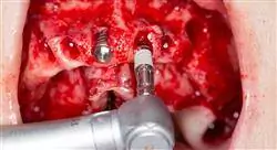 cursos periimplantitis y cirugía mucogingival en implantología