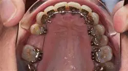 cursos ortodoncia lingual