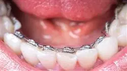 experto ortodoncia lingual 