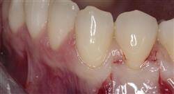 maestria periodoncia y cirugía mucogingival