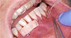 magister periodoncia y cirugía mucogingival