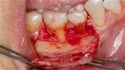 curso periodoncia endodoncia 1u