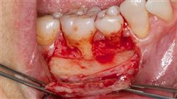 curso periodoncia y endodoncia