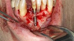 curso mantenimiento paciente periodontal implantado 