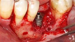 diplomado mantenimiento paciente periodontal implantado 