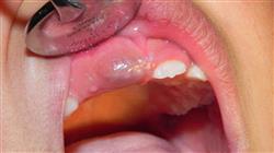 formacion anatomopatologia cavidad oral lesiones elementales Tech Universidad