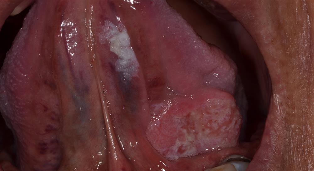 curso experto metodos diagnosticos anatomopatologia patologia oral asociada enfermedades sistemicas Tech Universidad