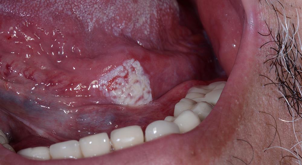 posgrado experto metodos diagnosticos anatomopatologia patologia oral asociada enfermedades sistemicas Tech Universidad