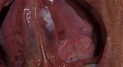 curso experto metodos diagnosticos anatomopatologia patologia oral asociada enfermedades sistemicas Tech Universidad