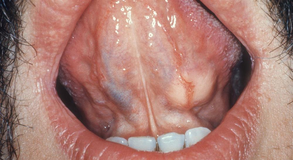 curso experto medicina oral patologias elementales glandulas salivales atm neuropatias Tech Universidad