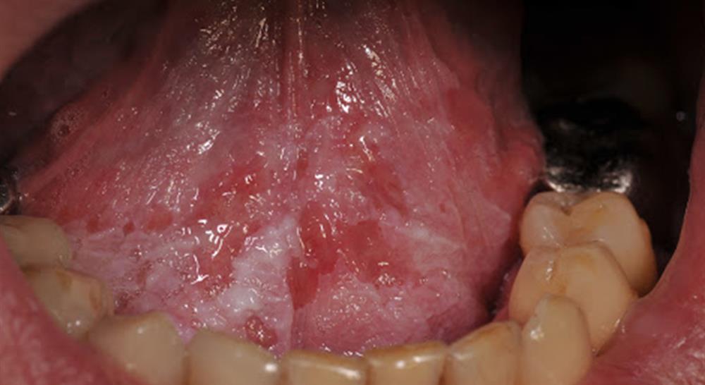 formacion experto lesiones oseas quistes tumores medicina oral Tech Universidad