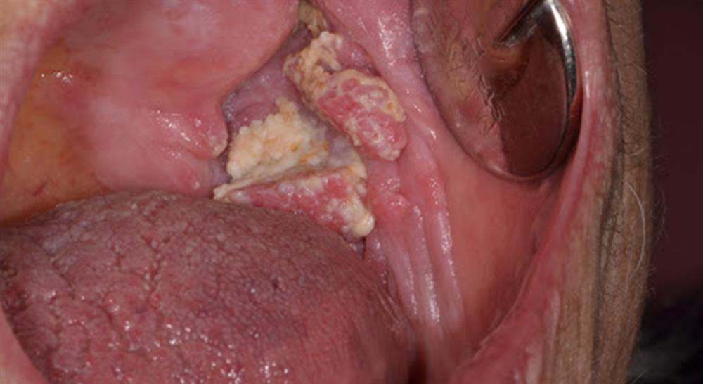 posgrado experto lesiones oseas quistes tumores medicina oral Tech Universidad