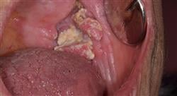 posgrado experto lesiones oseas quistes tumores medicina oral Tech Universidad