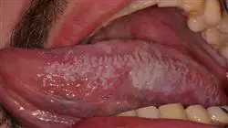 curso patologia oral inflamatoria infecciosa TECH Universidad