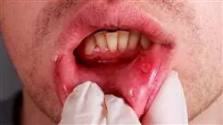 formacion patologia oral inflamatoria infecciosa Tech Universidad
