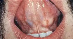 diplomado tumores benignos cavidad oral Tech Universidad